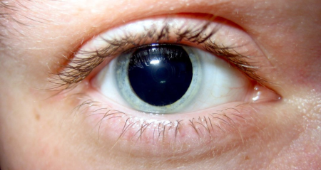 example of dilated pupils for an eye exam